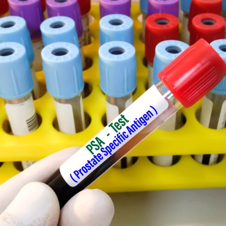 PSA test