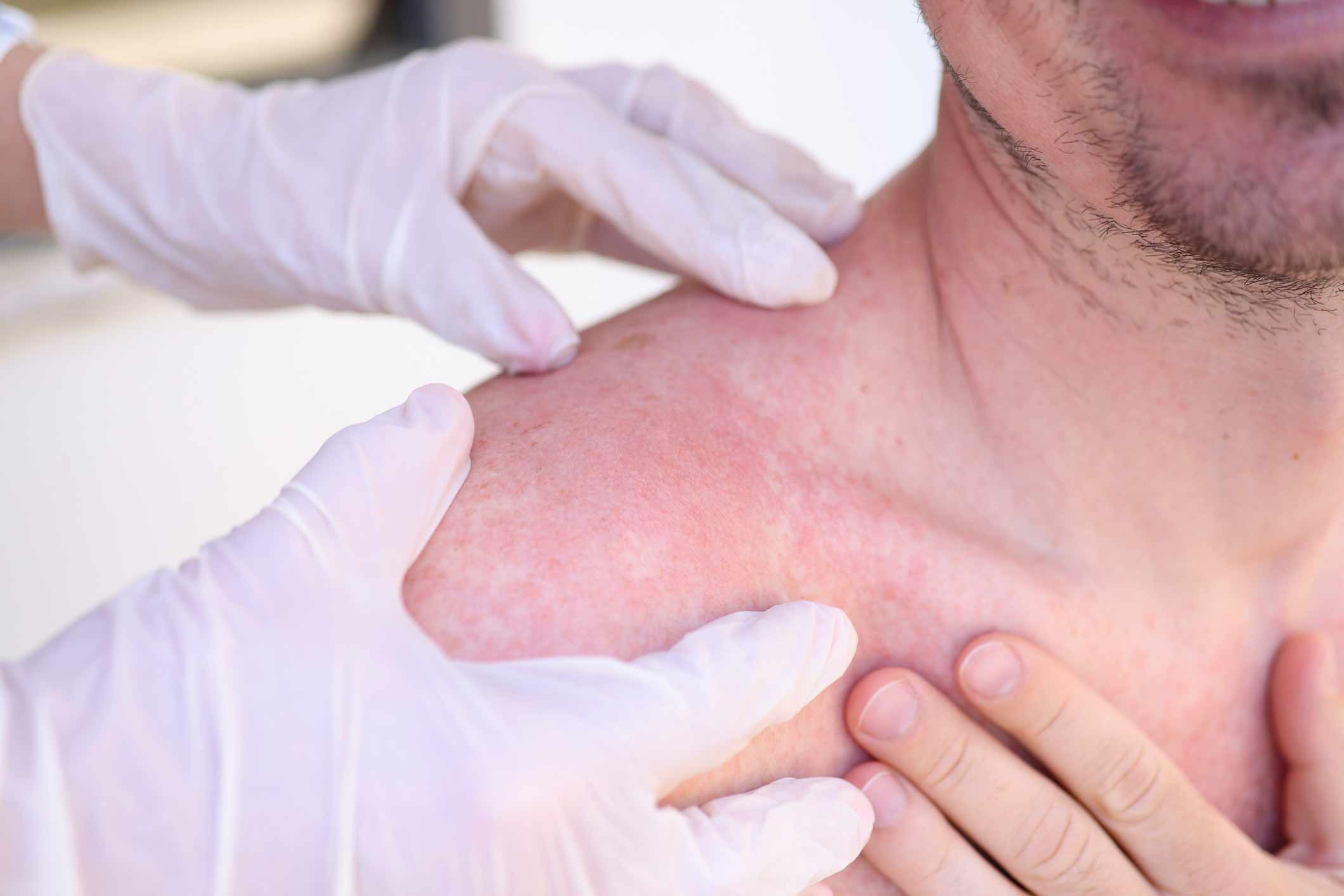 man having skin checked by doctor