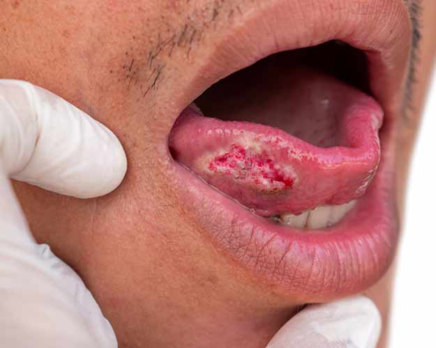 Squamous cell carcinoma of tongue. Oral cancer or malignant tumor.