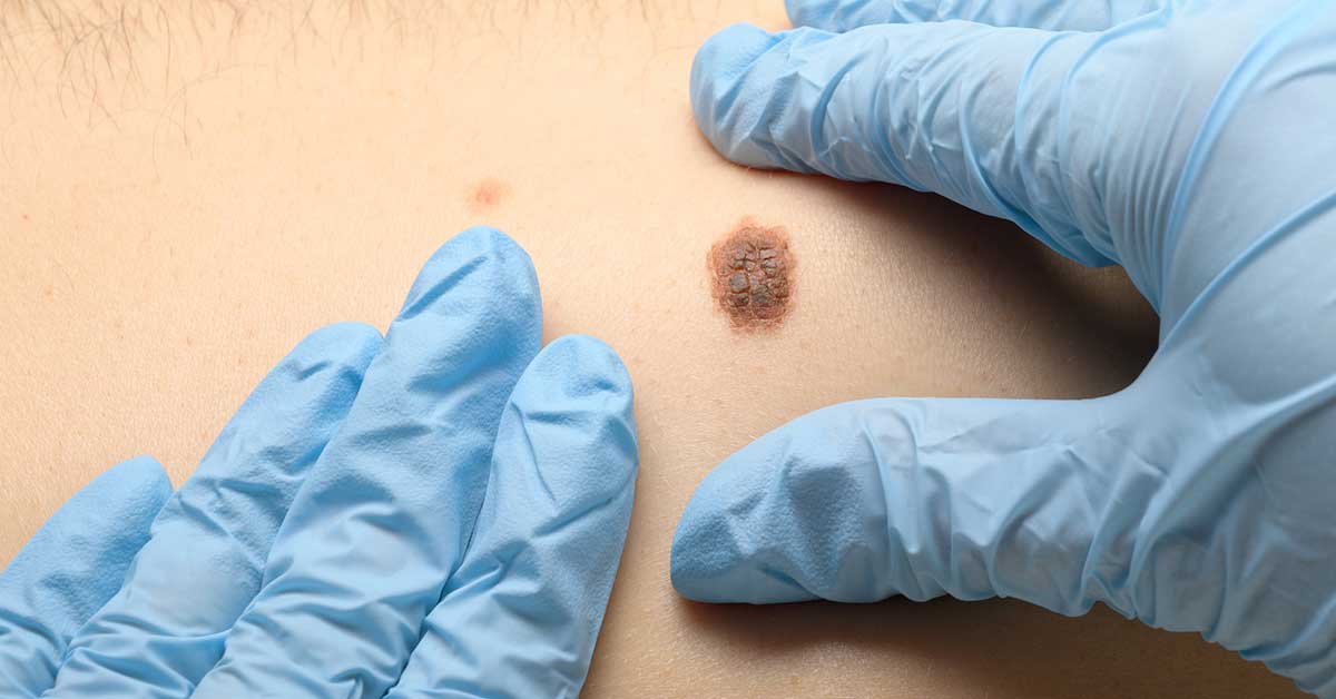 Skin Cancer Mole
