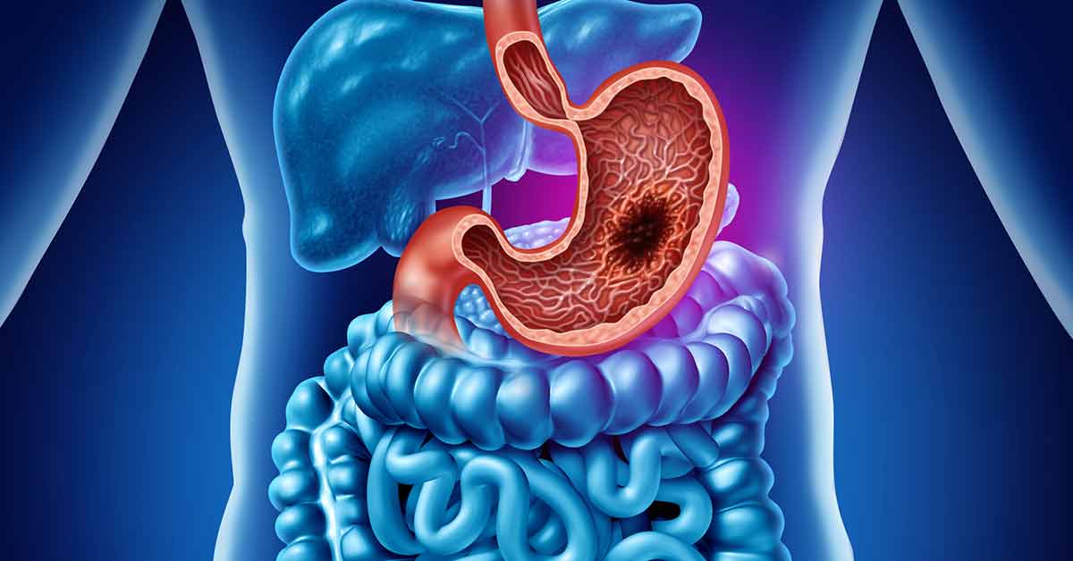 Gastrointestinal Stromal Tumor