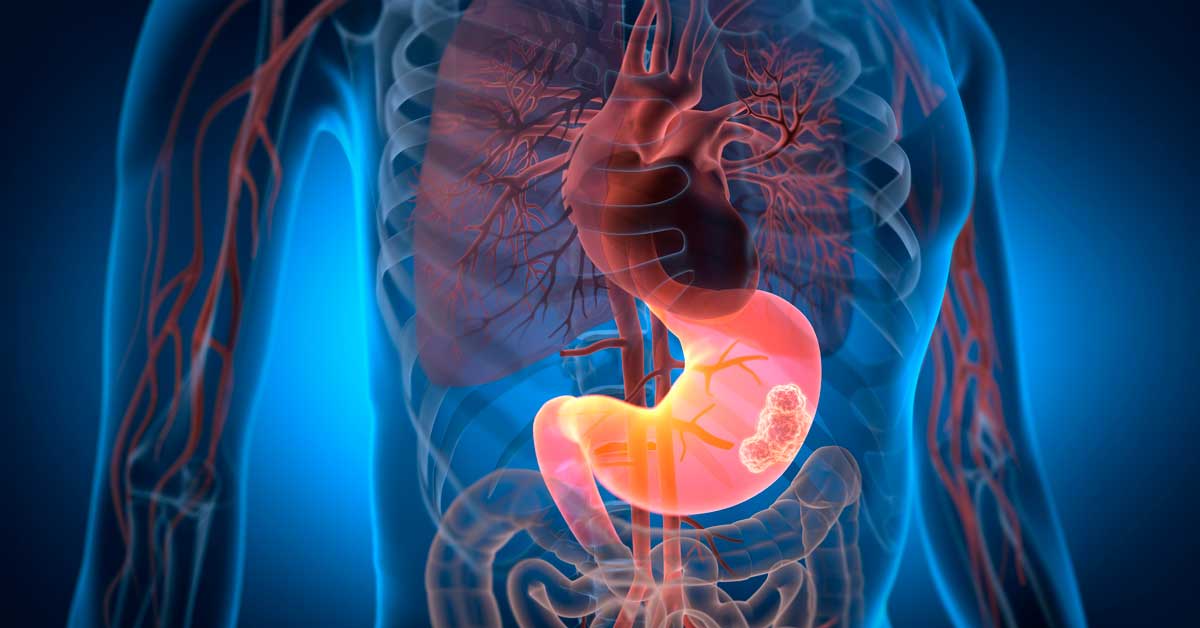 Stomach Cancer Rendering