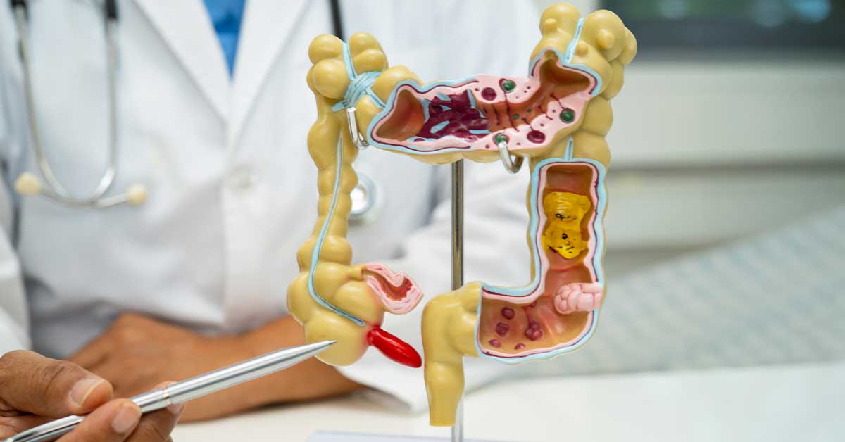 Intestine, appendix and digestive system, doctor holding anatomy model for study diagnosis and treatment